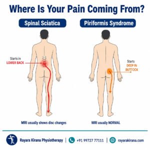 Comparison infographic showing spinal sciatica starting in the lower back and radiating down the leg versus piriformis syndrome starting deep in the buttock and extending toward the knee.